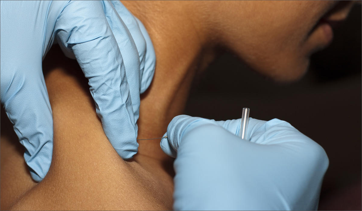 The opioid crisis has spurred a movement in medicine to find alternatives, including non-pharmacological options like dry needling. CREDIT DR. HEATHER TICK