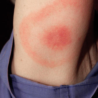 When a deer tick carrying the Lyme disease bacteria bites, the resulting rash can look like this bull's-eye.