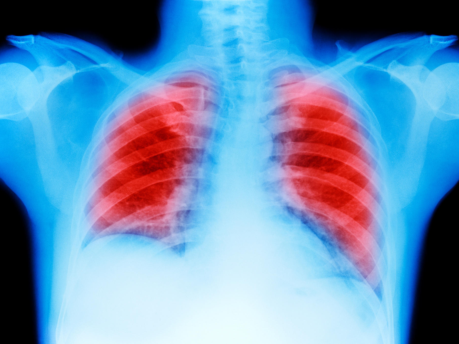 Merck Immunotherapy Drug Shines In Lung Cancer Study
