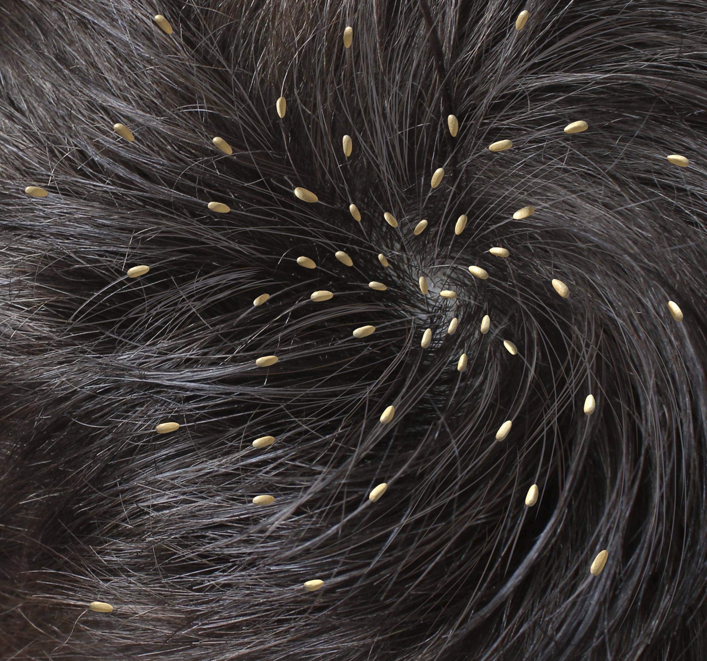 Where can you view photos of head lice?