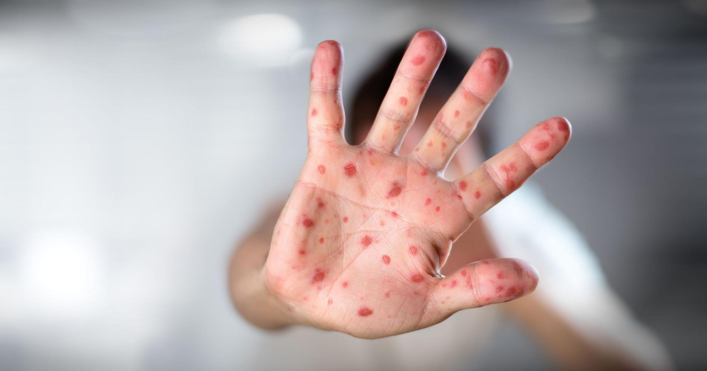 U.S. Measles Cases Already Top Last Year’s Total