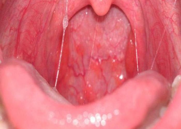 throat gay Vascular