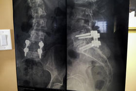 The X-ray of nurse Tove Schuster's spine shows the metal cage and four screws her surgeon used to repair a damaged disk in her back. Terry Cawthorn underwent a similar procedure.