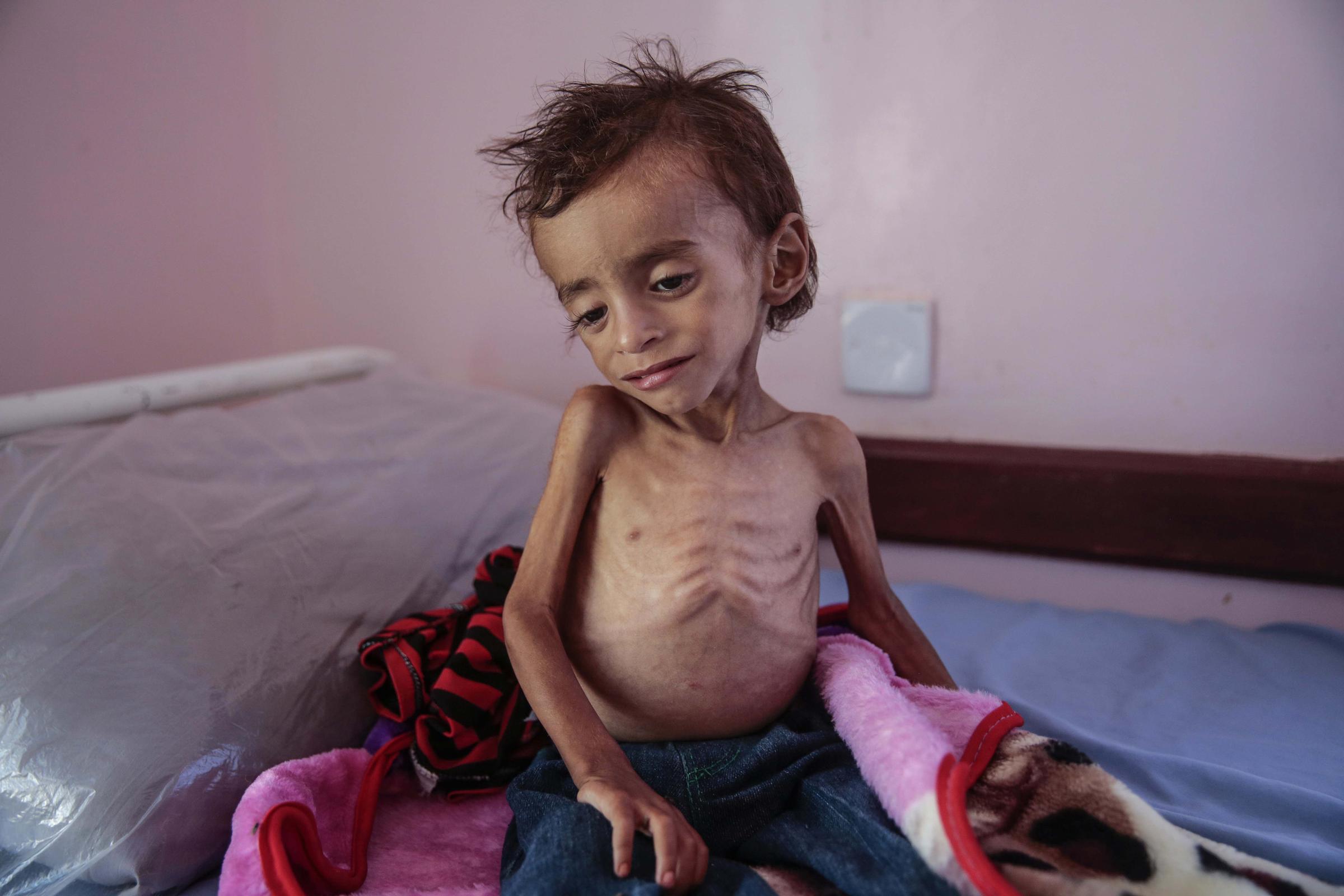 Image result for yemen starving