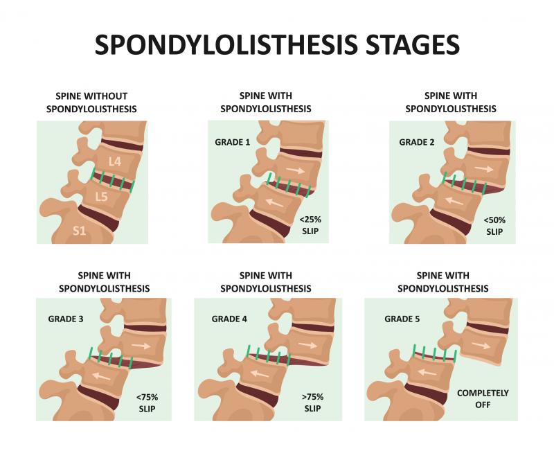 Spondylolisthesis Another Good Reason To Take Better Care Of Your Back