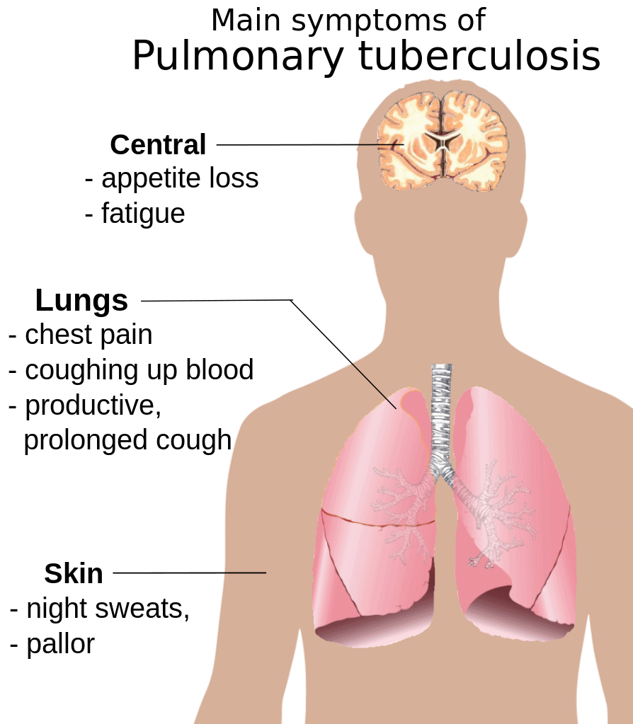 tuberculosis-and-tb-testing-morning-sign-out-at-uci