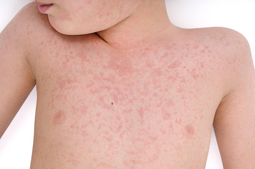 Measles Reported In Tulsa County Public Radio Tulsa