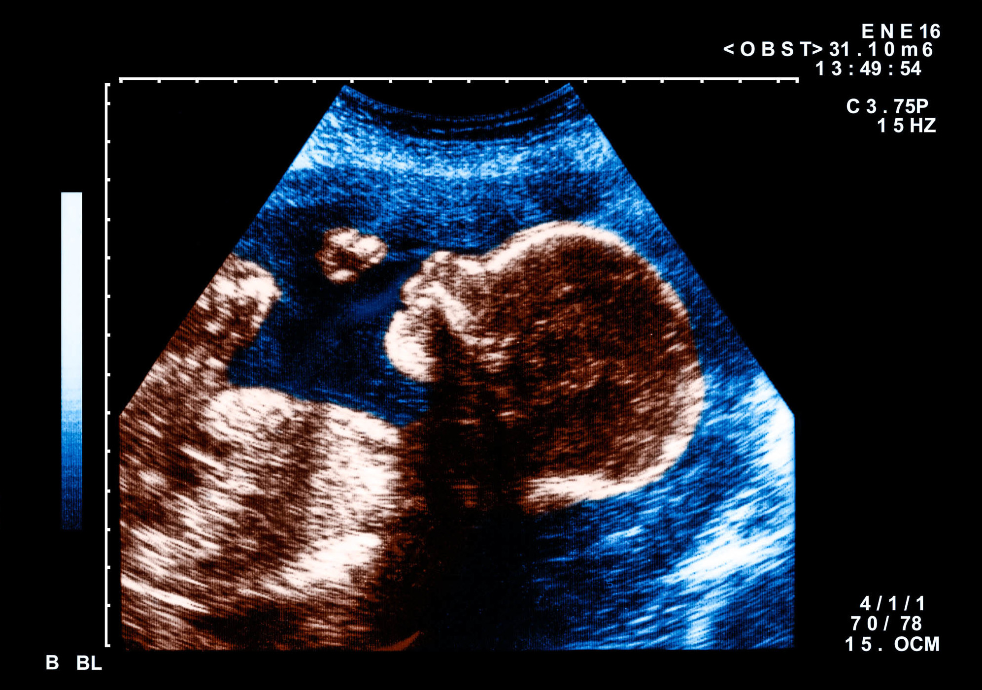 Fetuses Respond To Face Like Patterns Study Suggests Krwg