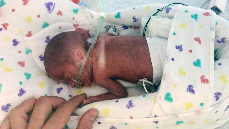 1 Pound Baby Born Early Aboard Cruise Ship Survives Public Radio Tulsa