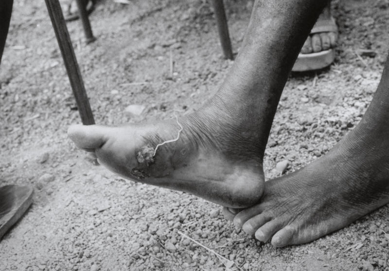 Amazing News About The Awful Guinea Worm Health News Florida