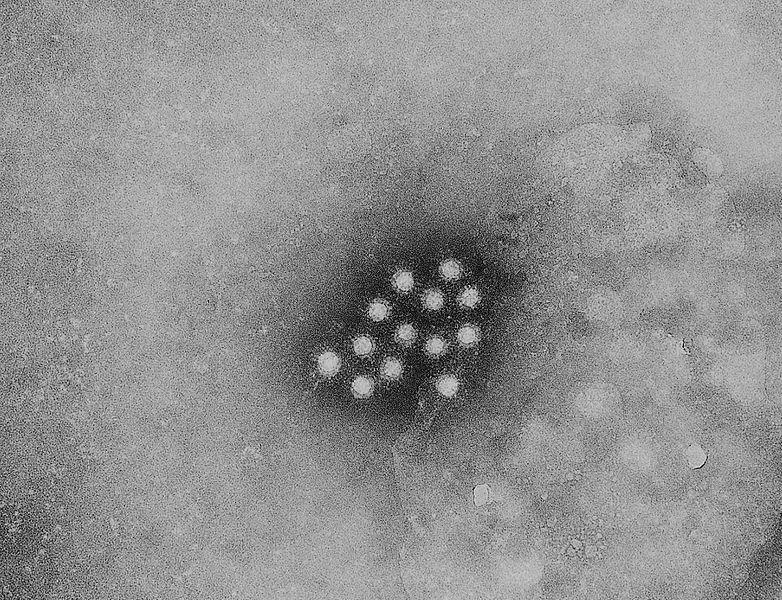 Hepatitis A Outbreak Nears 1,500 Cases | WUSF News