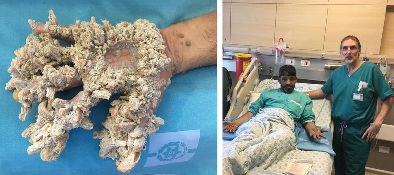 Patient With 'Tree Man' Syndrome Says He 'Can Finally Live A Normal