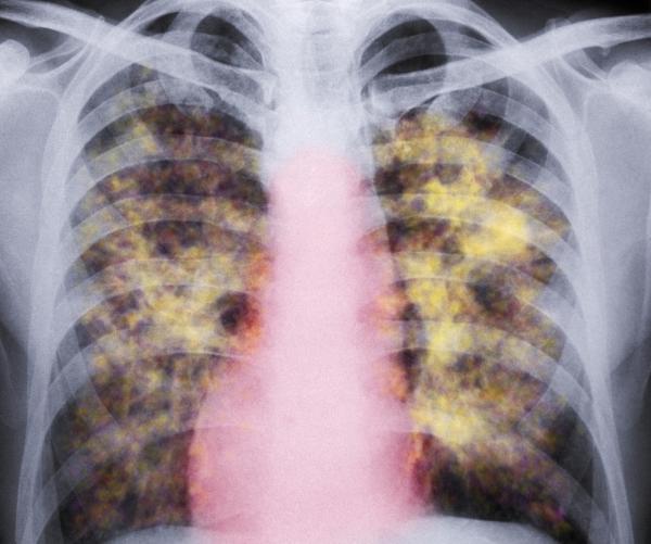 Pneumoconiosis - Pictures