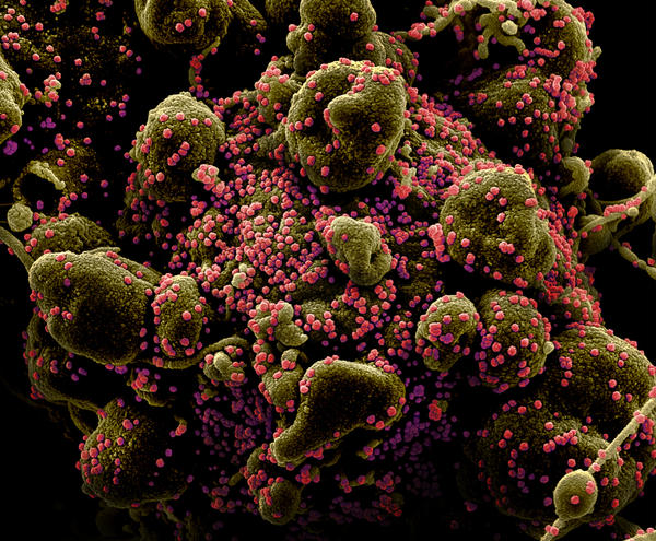 A colorized image of cells from a patient infected with the coronavirus SARS-CoV-2. The virus particles are colored pink. The image was captured from a scanning electron micrograph.