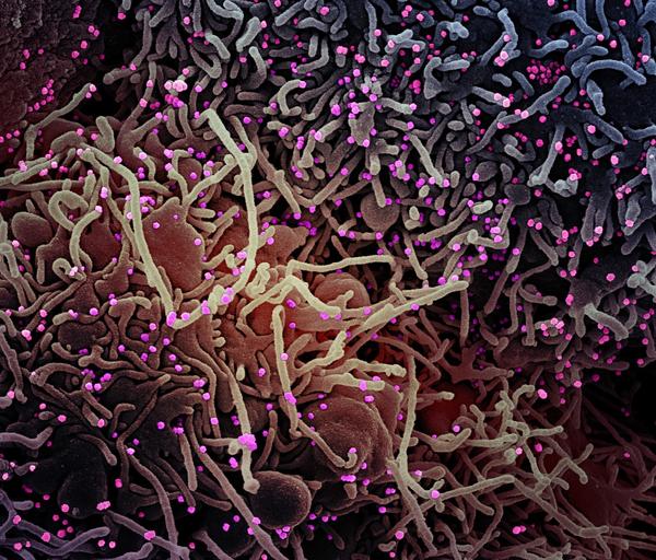 This image made by a scanning electron micrograph shows SARS-COV-2 virus particles (colorized pink) from a patient sample. There are various studies looking at changes to the virus genome — and the possible impact on how the virus affects humans.
