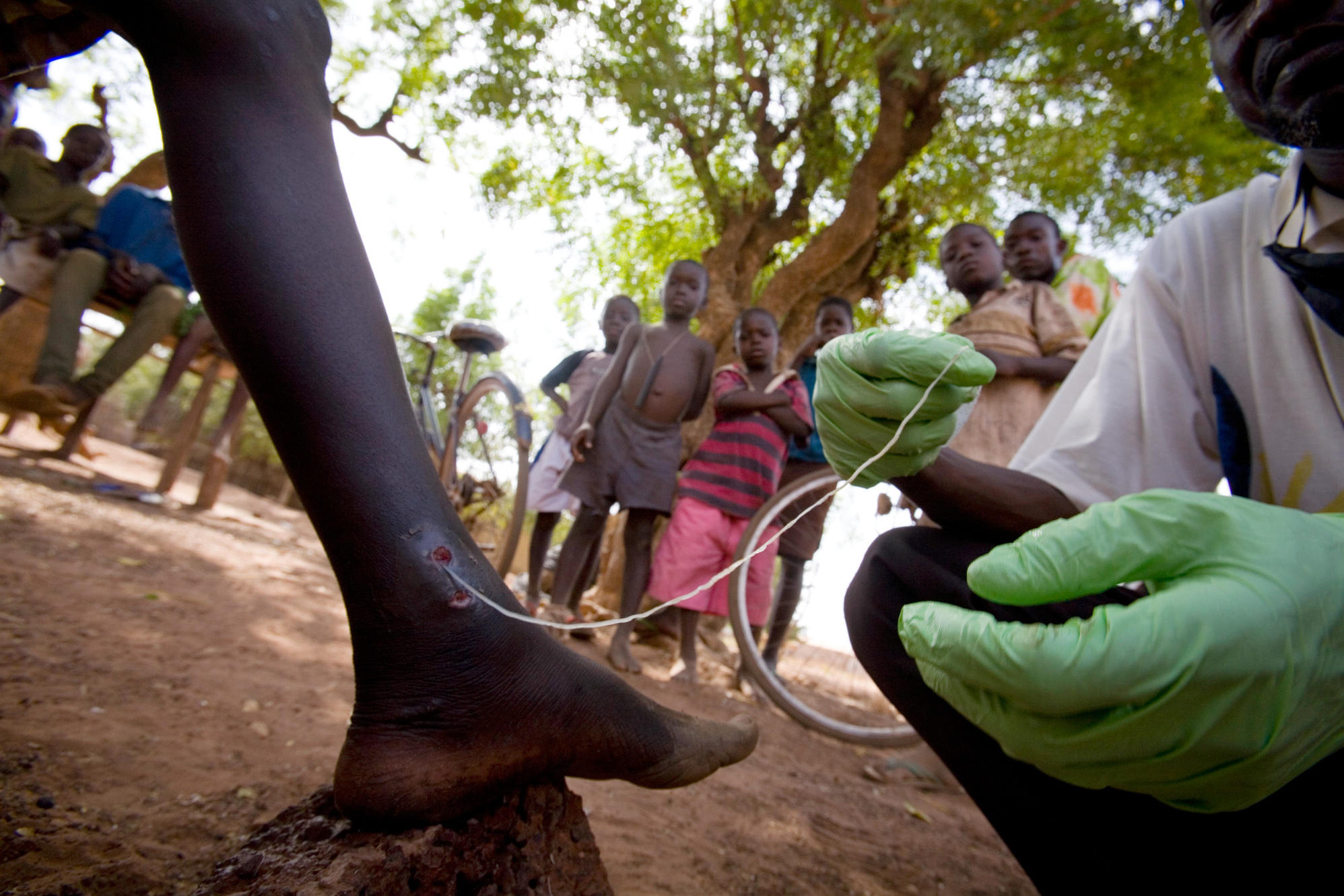 the-last-days-of-guinea-worm-health-news-florida