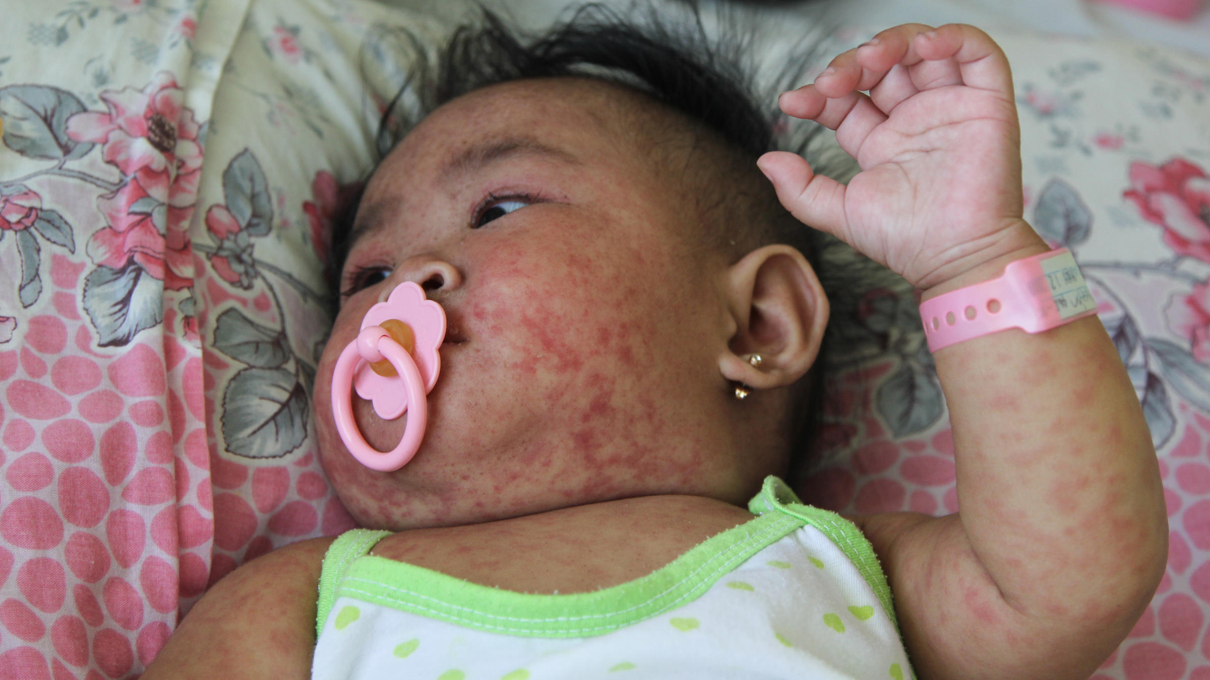 The Philippines Is Fighting One Of The World's Worst Measles Outbreaks