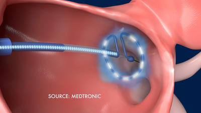 New Atrial Fibrillation Device Shows Promise | WCBE 90.5 FM