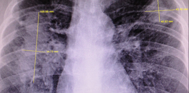 lung disease caused by silica dust