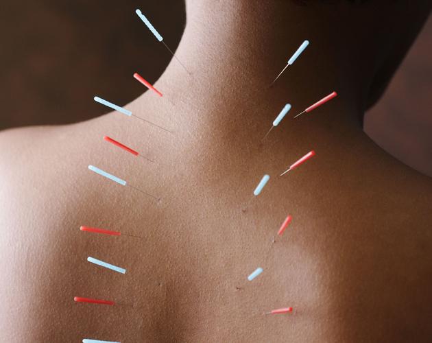 medicare-to-cover-some-acupuncture-in-aafp-advocacy-win